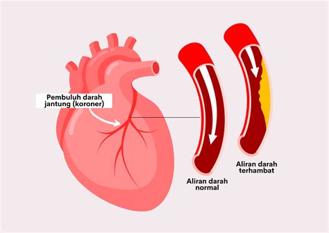 Bagaimana Cara Mencegah Terjadinya Penyakit Jantung Koroner